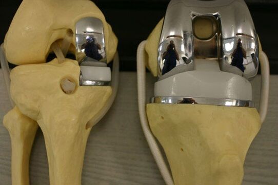 Variants of endoprostanics of knee joint