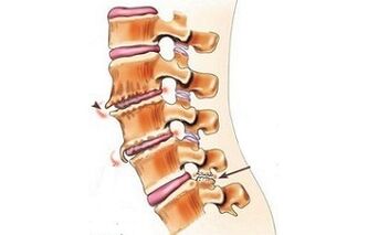 spondylarthosis as the causes of back pain