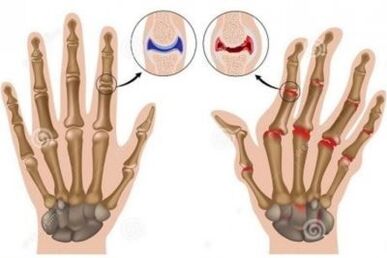 Causes of pain in the fingers joints