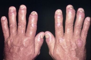 Why the fingers have a pain in the fingers