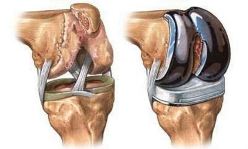 Endoprosttics of the knee joint for arthrosis