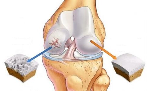 Healthy joint and joint joints of the knee joint