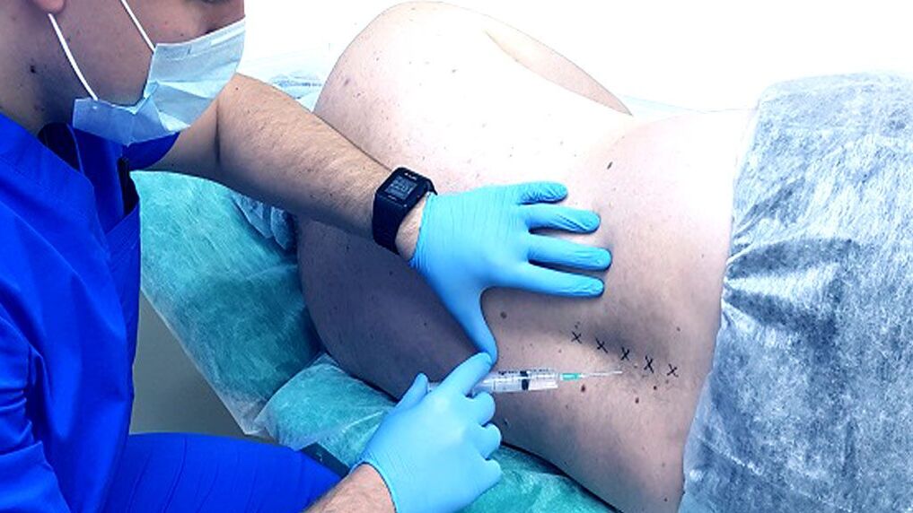 Spinal block to osteochondrosis