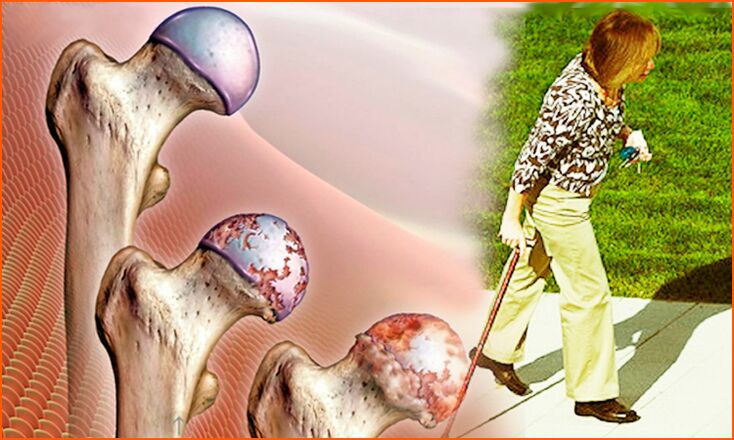 Permanent lameness in the last stage of arthrosis of the hip joint