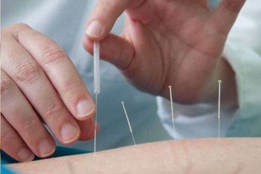 Acupuncture is a method for treating lumbar pain caused by osteochondrosis