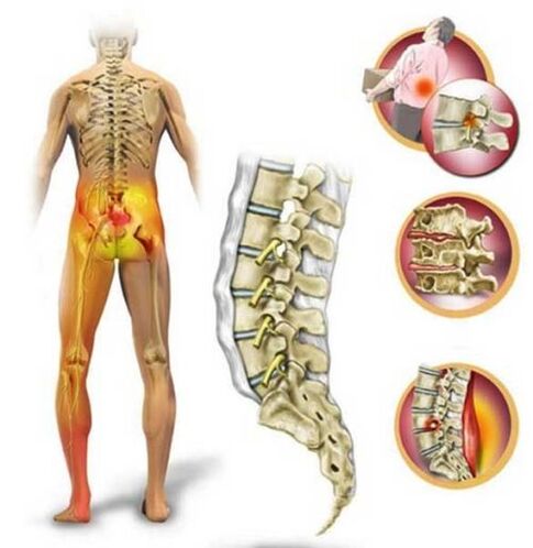 Osteochondrosis of the lumbar spine, which causes lower back pain