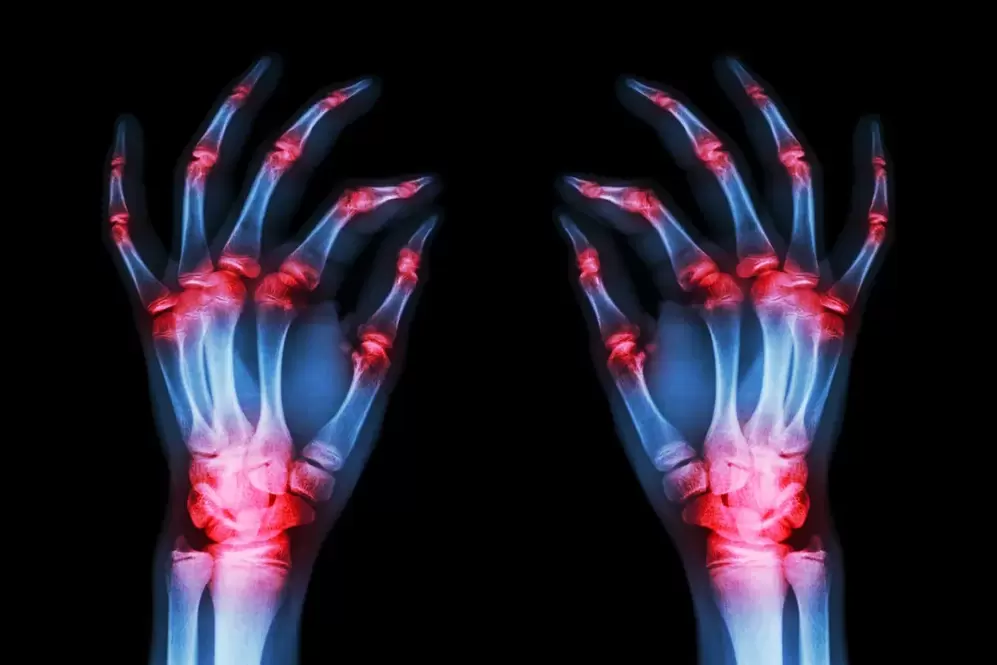 arthrosis of the finger joints
