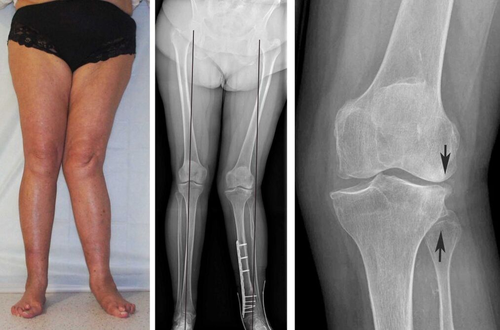 clinical picture of osteoarthritis of the knee