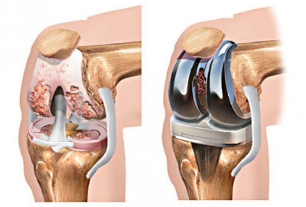 knee joint surgery for arthrosis